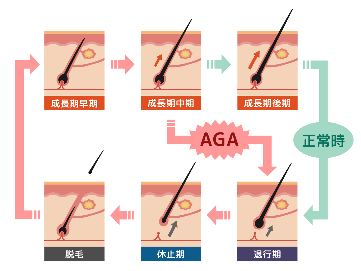 AGA（男性型脱毛症）乱れたヘアサイクル